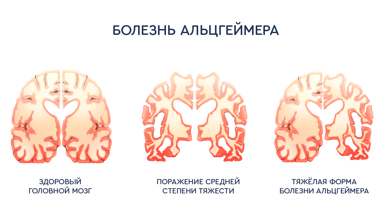 alsgeymer sabablari rivojlanishi va davolash haqida malumot 65da48ecc6dcd