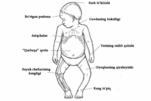 bolalarda raxit kasalligining asosiy belgilari 65caad9ad3571