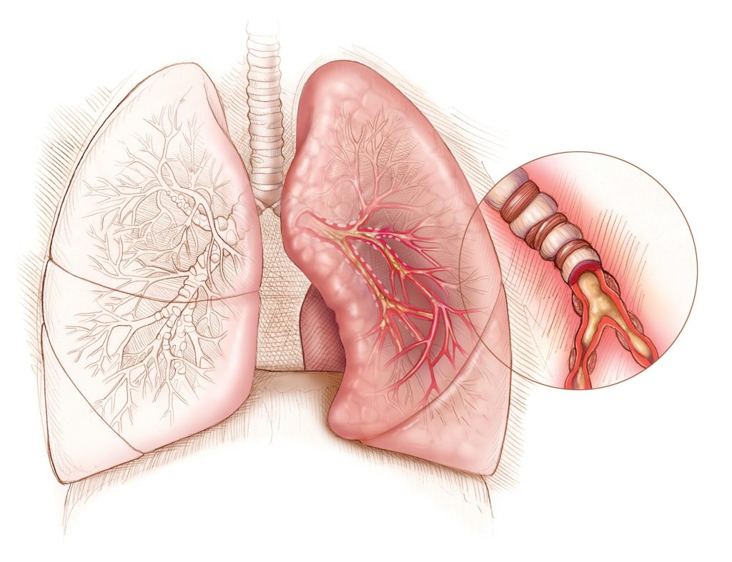 bronxial astma kasalligini uy sharoitida davolash mumkinmi 65d369bd494c0
