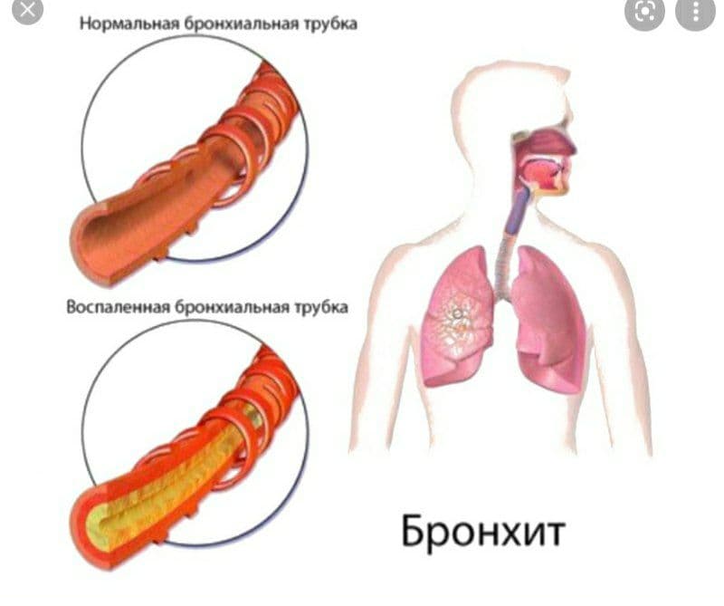 bronxit haqida batafsil haqida toliq malumot oling 65d0a4343b8a2