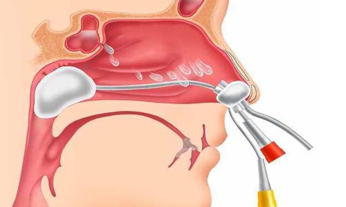 burun va burun yondosh boshliqlari poliplarini davolash usullari haqida malumot 65da28a6abc84