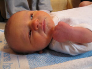 Chaqaloqlarda fiziologik sariqlik(Neonatal sariqlik) 2 chaqaloqlarda fiziologik sariqlikneonatal sariqlik 65cade65508c4