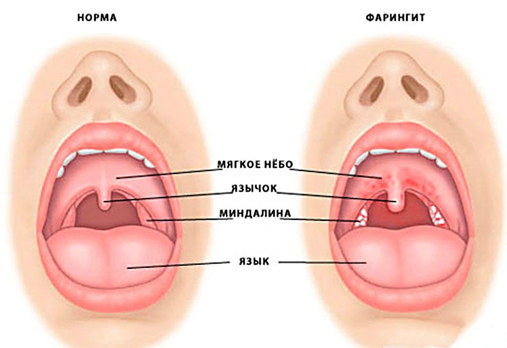 faringit kasalligi sabablari va davolash haqida malumot 65da4aa57f971