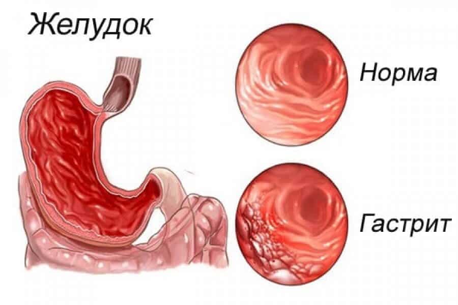 gastritni davolash belgilari va sabablari va turlari 65d37197b3ebc