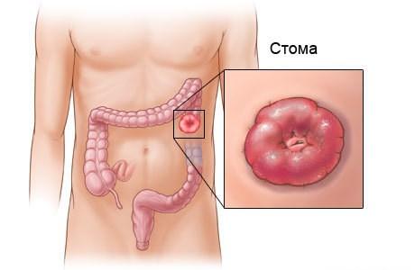 ichak stomasi nima va operatsiya 65d366c79d7cd