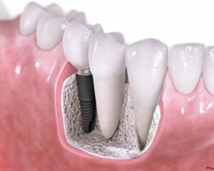 implantant ozi nima 65cb25a616af7