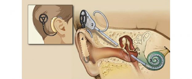 koxlear implantatsiyasi va ajoyib natijalar haqida malumot 65da2ba23641f