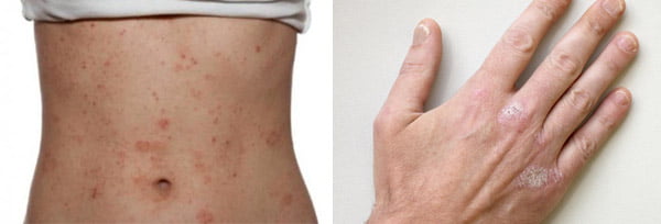 neyrodermit haqida malumot 65da220d58cf3