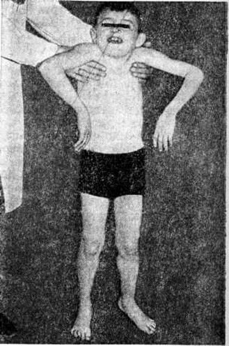 oppengeym miopatiyasi haqida malumot 65da2217ad50c