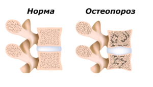 osteoporoz xastaligi haqida 65cae8035e16b