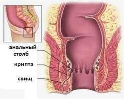 otkir paraproktit sabablari belgilari turlari va davolash yollari 65d37258ac693