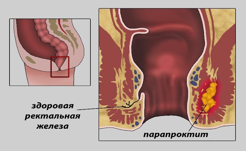 otkir paraproktit sabablari belgilari turlari va davolash yollari 65d3725b62d1e