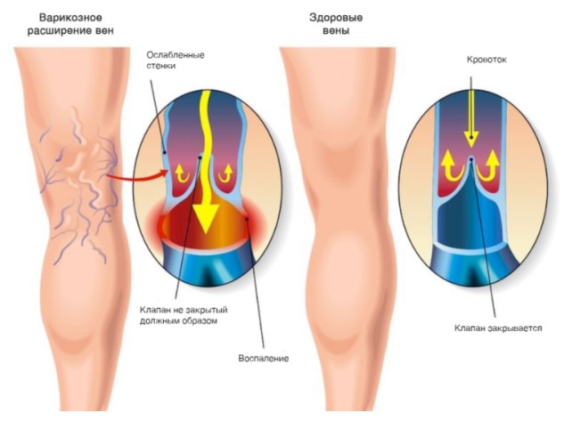 oyoqlardagi varikoz tomirlari kasallik sabablari belgilari va davolash 65d36b0284c0c