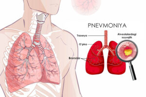 pnevmoniyazotiljam kasalligi haqida 65caacb648942