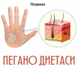 psoriaz kasalligida pegano diyetasi 65caae7a83bcd