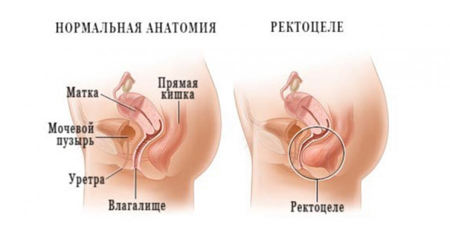 rektosel kasalligi belgilari sabablari xavfli omillari va davolash 65d368420e6c4