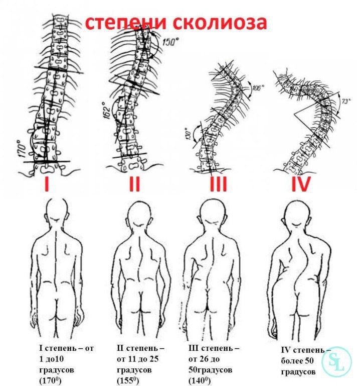 skolioz bu umurtqa pogonasining yon tomonga qiyshayishi haqida toliq malumot oling 65d090d0942a0