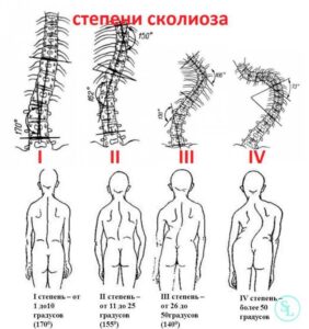 skolioz bu umurtqa pogonasining yon tomonga qiyshayishi 65caa7716c482