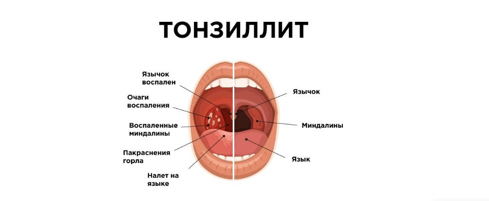 tonzillit sabablari turlari va davolash haqida malumot 65da4a825c521