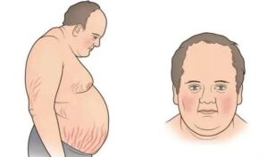 itsenko kushing sindromi 65caa9e0d375e