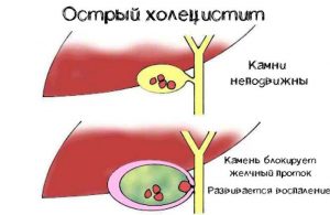 xolesistit kasalligi sabablari belgilari va davolash 65d3722734dce