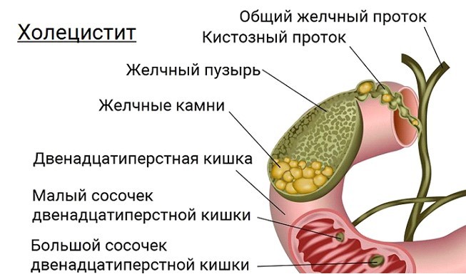 xolesistit kasalligi sabablari belgilari va davolash 65d37227bc57c