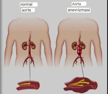 aorta anevrizmasi nima sabablari 65f048c15b012