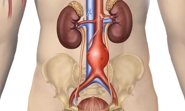 aorta anevrizmasi nima sabablari 65f048c1a8192