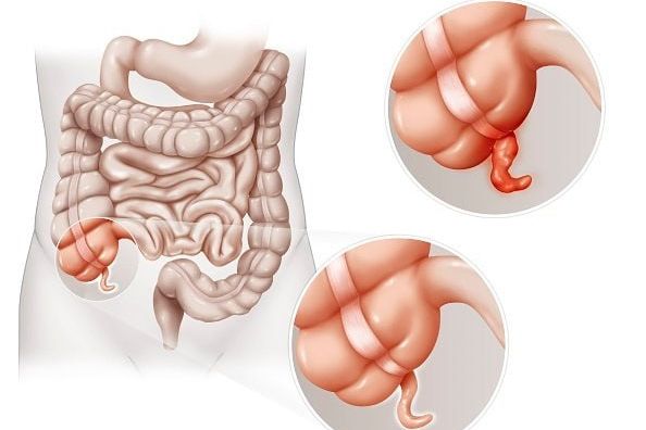 appenditsit nima va belgilari 65f04c4cbd38b