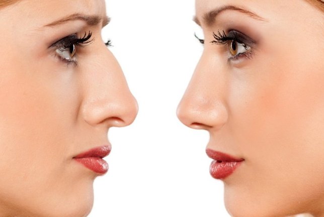 Burun estetikasi rinoplastika nima 2 burun estetikasi rinoplastika nima 65f044a7ecaf7
