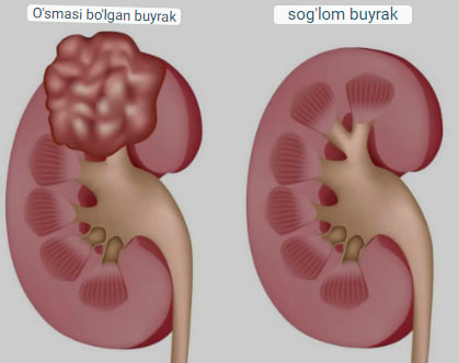 buyrak saratoni sabablari belgilari va davolash 65f043be1598f