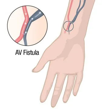 fistula nima belgilari va davolashi 65f70fdd57e5c