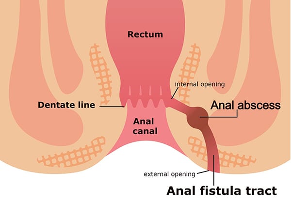 fistula nima belgilari va davolashi 65f70fdda5109