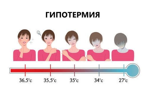 gipotermiya sabablari belgilari va davolash usullari 65f04239df41a