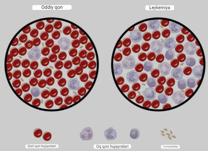leykemiya qon saratoni nima semptomlar va davolash 65f043b4aeb43