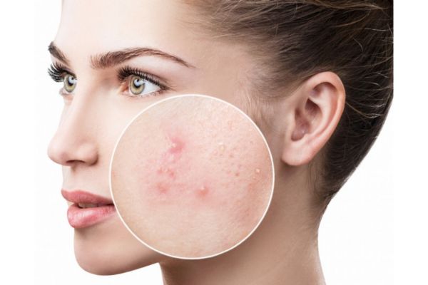 nima uchun akne husunbuzar paydo boladi 65f04e40e269a