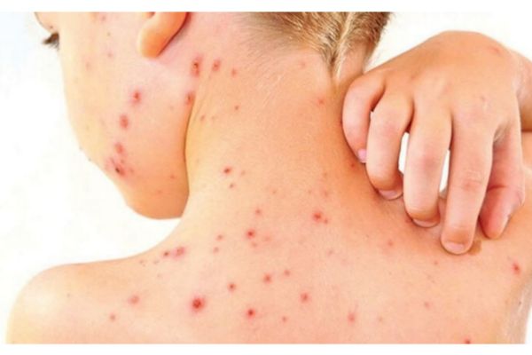 qizamiq nima uning belgilari va davolash usuli 65f04e8c002da