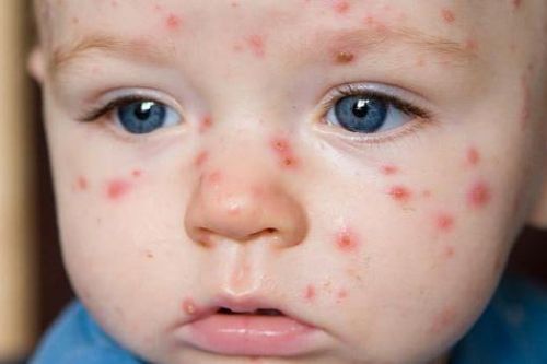 suvchechak nima belgilari va davolash usuli 65f04d00d5d23