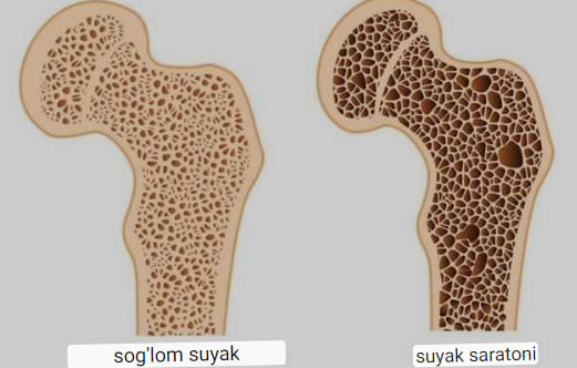 suyak iligi saratoni belgilari va davolash usullari 65f04479635d5
