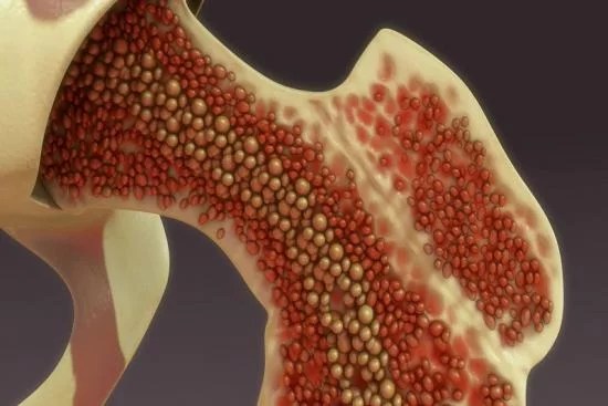 Suyak iligi saratoni: belgilari va davolash usullari 2 suyak iligi saratoni belgilari va davolash usullari 65f0447a07168