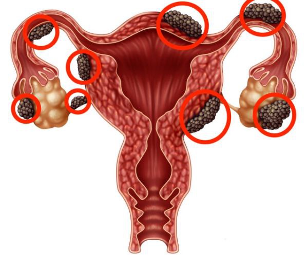 endometrioz korinmas ogriqning kelib chiqishi 66213fd448bb2