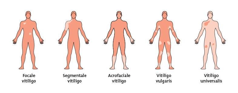 vitiligo nima semptomlar va davolash usullari 670401f578aa2