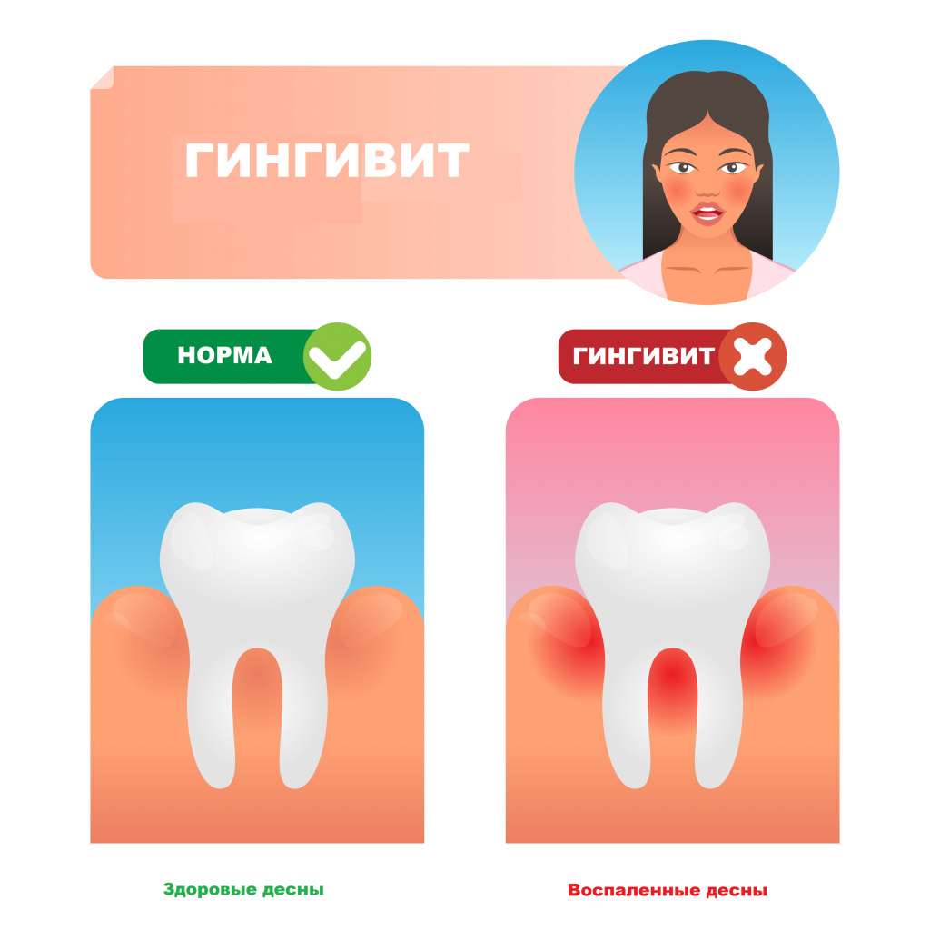 gingivit belgilari sabablari va davolash usullari 6730d4f3e83f5