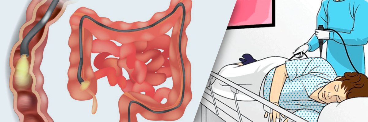 kolonoskopiya ichak salomatligini nazorat qilishning muhim usuli 673f556490dd8