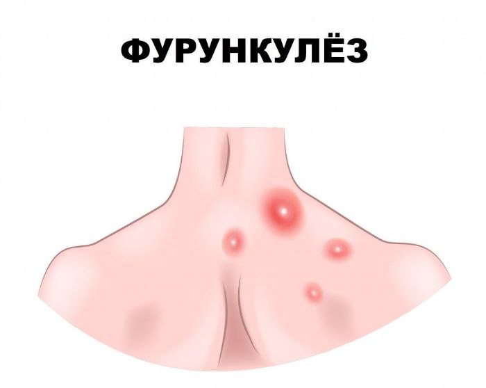 furunkulyoz sabablari belgilari va davolash usullari 67b207d4cf33e