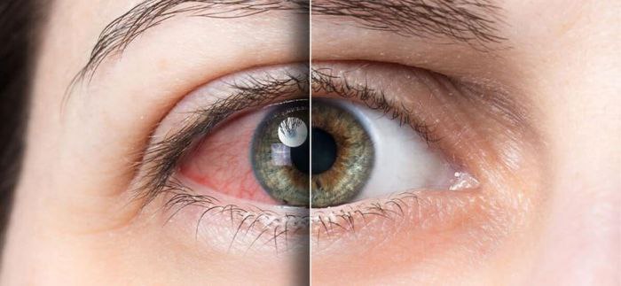 Quruq ko‘z sindromi: sabablari, belgilari va davolash usullari