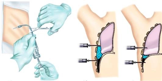 plevrit sabablari belgilari va davolash usullari 67e6c3f6dfd24