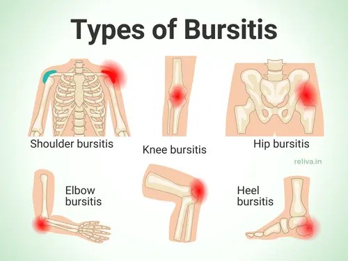 Tendinit Nima? Alomatlari, Turlari va Davolash Yo‘llari 3 tendinit nima alomatlari turlari va davolash yollari 68c591554f491