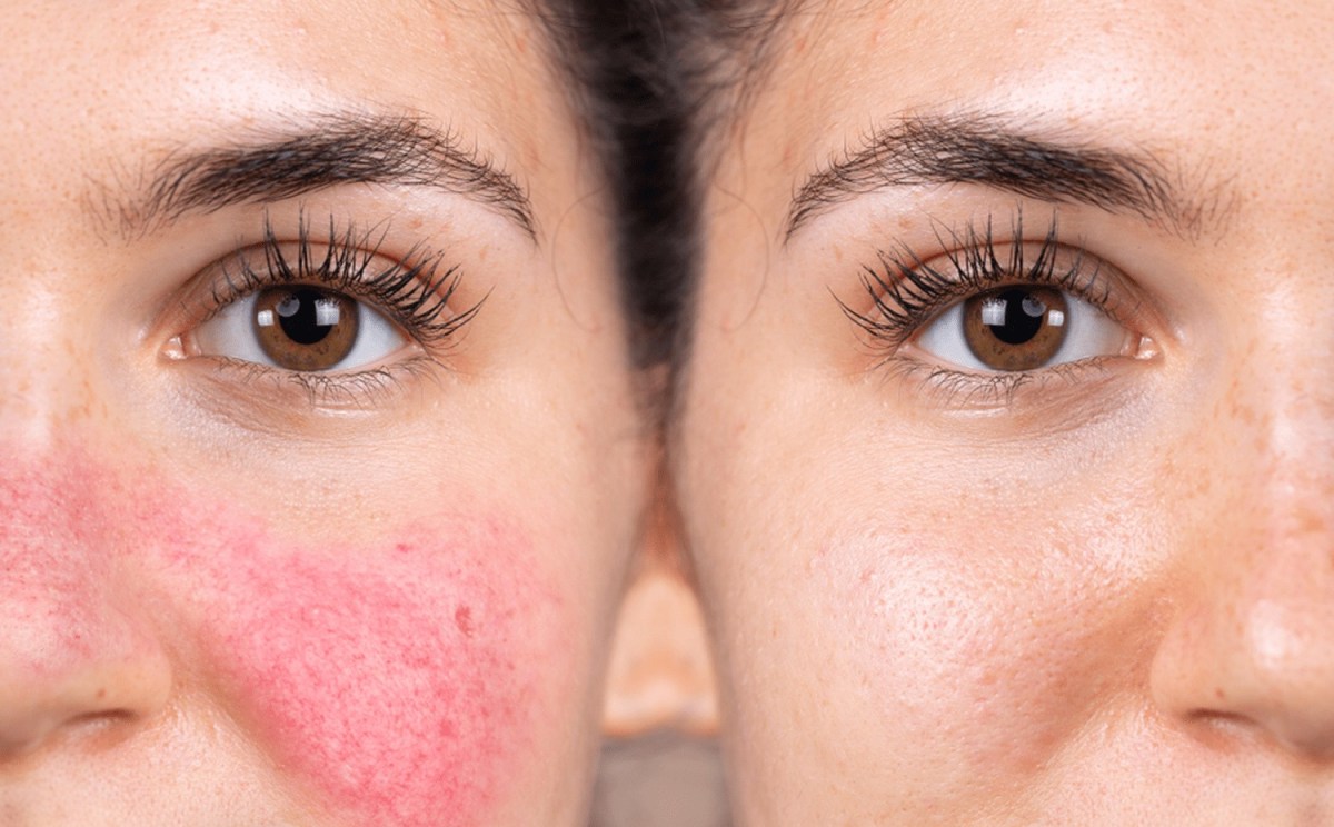 Yuz kuyishiga qarshi eng yaxshi parvarish usullari 2 yuz kuyishiga qarshi eng yaxshi parvarish usullari 68c43fe4b192a