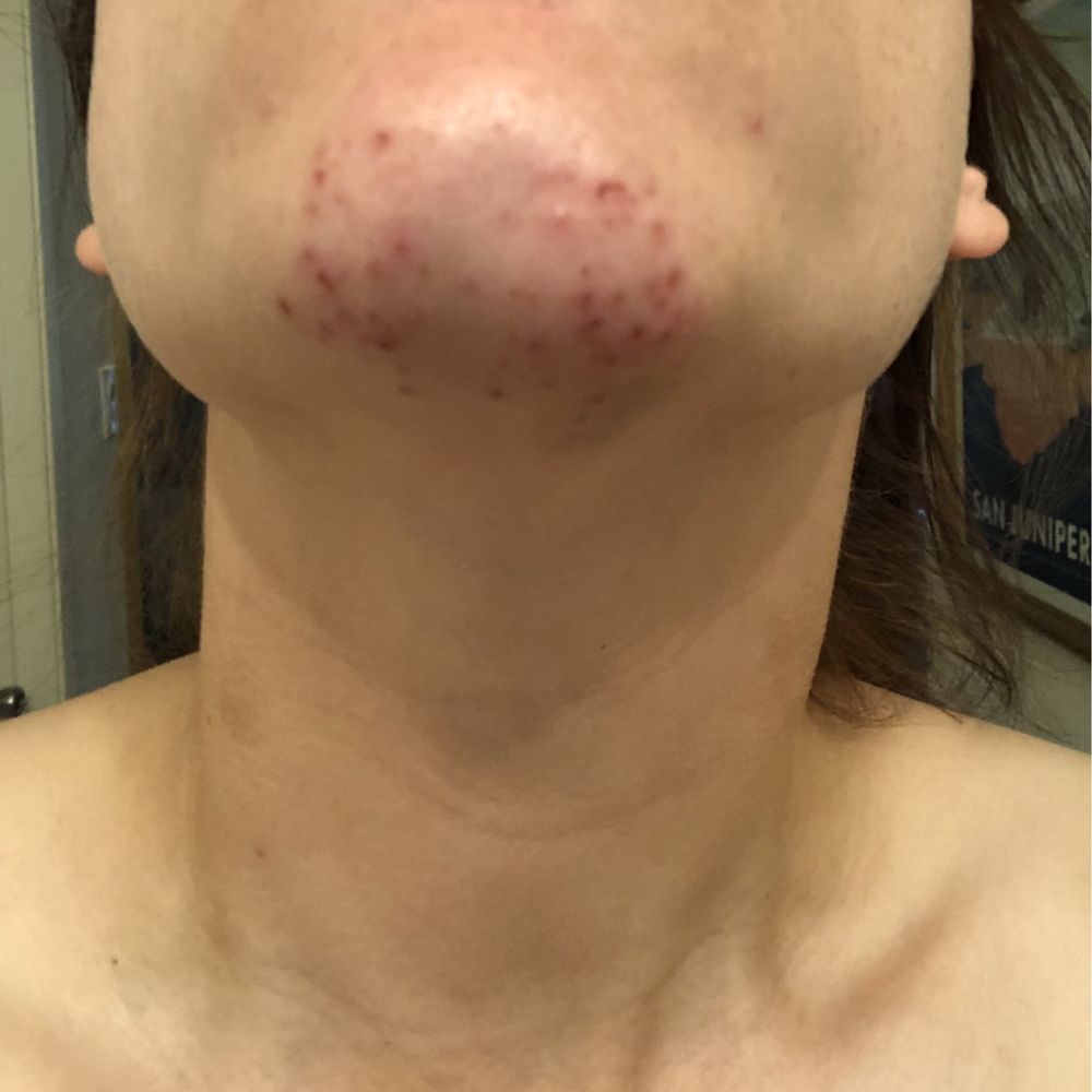 yuzga ignali epilyatsiya zararlari nimalardan ibd0berat 68d16f0d301be